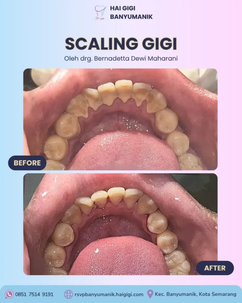 Scaling Gigi scaling-gigi-7-hai-gigi-banyumanik