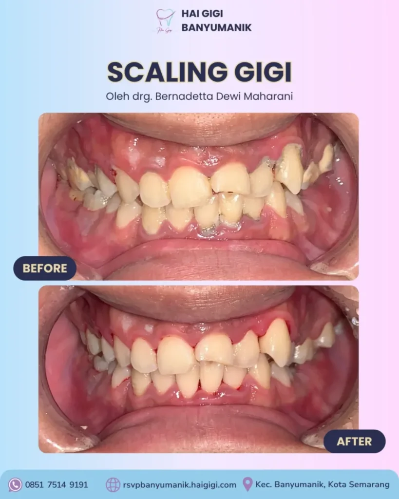 Scaling Gigi scaling-gigi-8-hai-gigi-banyumanik