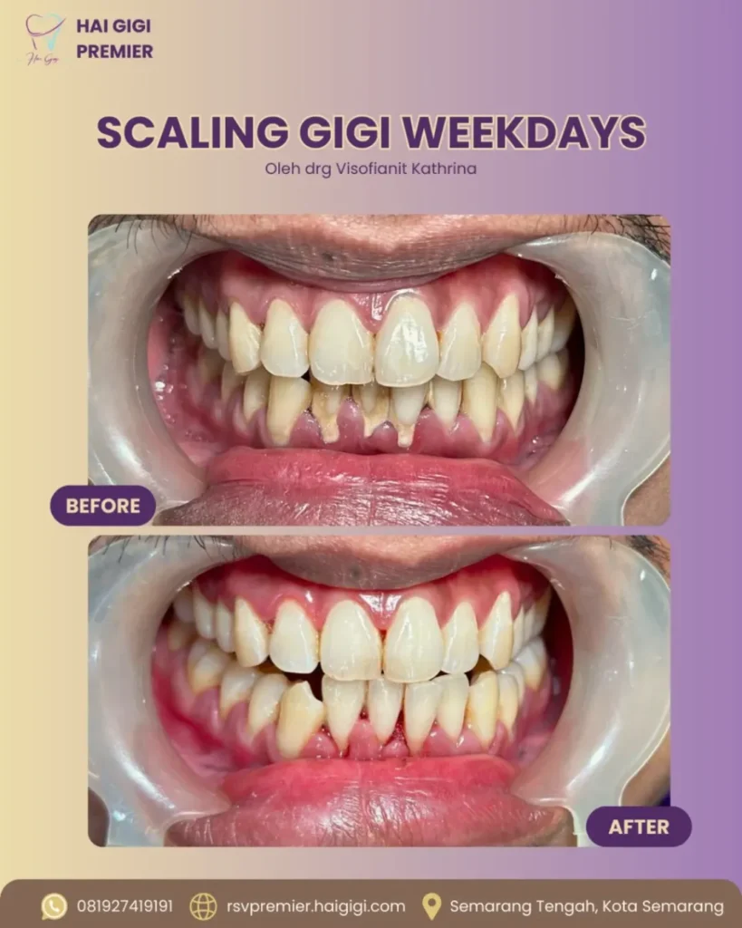 Scaling Gigi scaling-gigi-weekday-2-hai-gigi-premier
