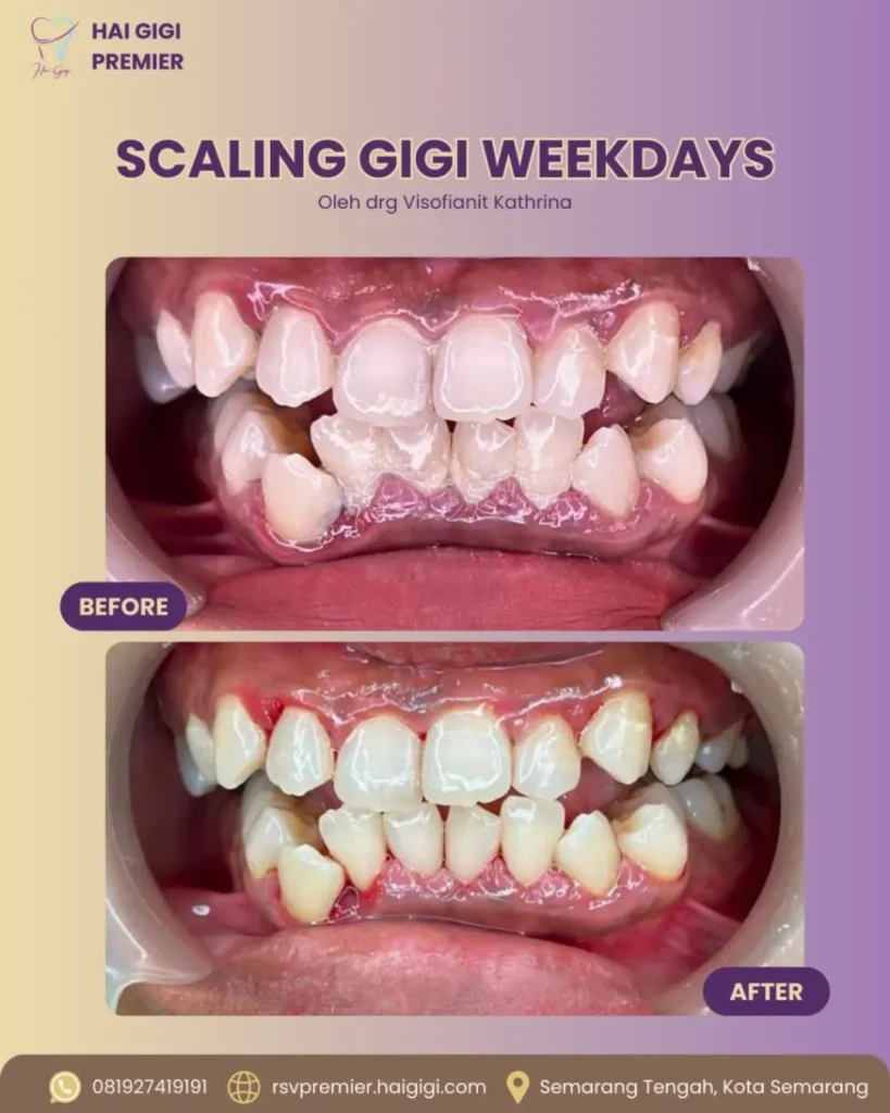 Scaling Gigi scaling-gigi-weekday-hai-gigi-premier