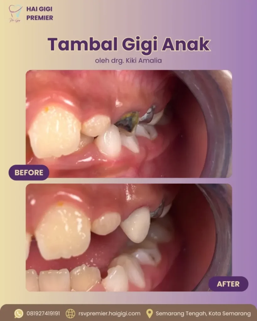 Perawatan Gigi Anak tambal-gigi-anak-2-hai-gigi-premier