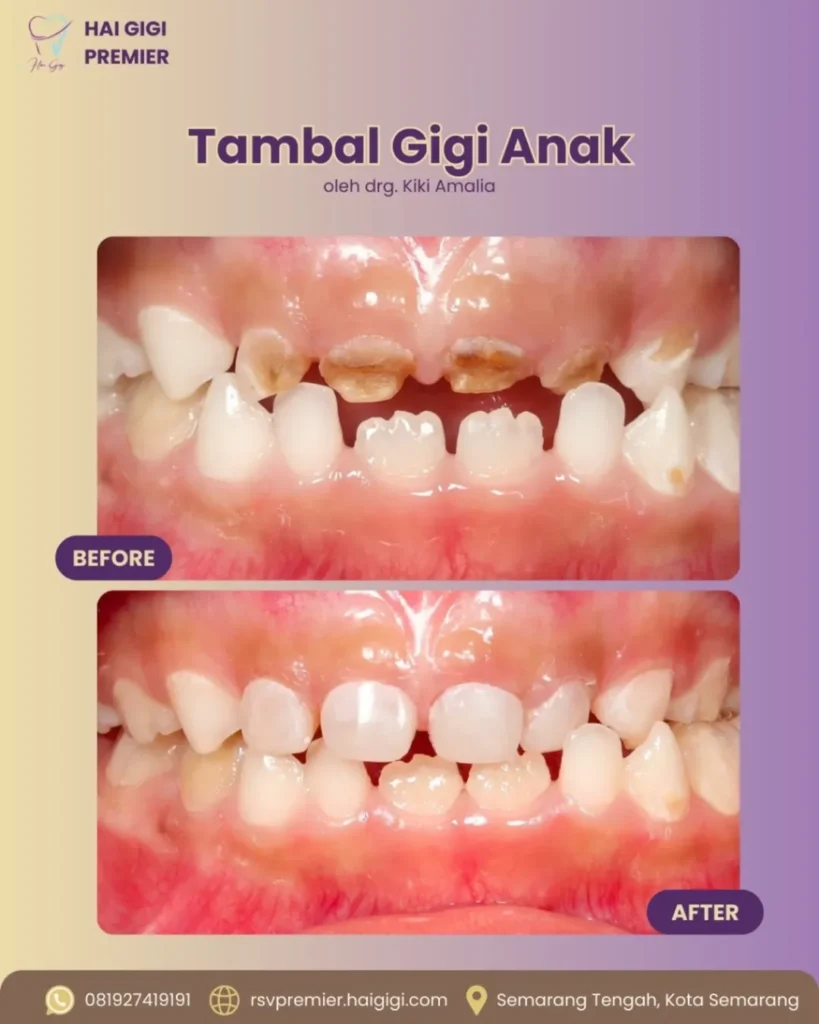 Perawatan Gigi Anak tambal-gigi-anak-3-hai-gigi-premier (1)