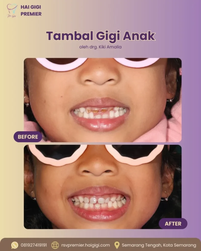 Perawatan Gigi Anak tambal-gigi-anak-3-hai-gigi-premier (2)