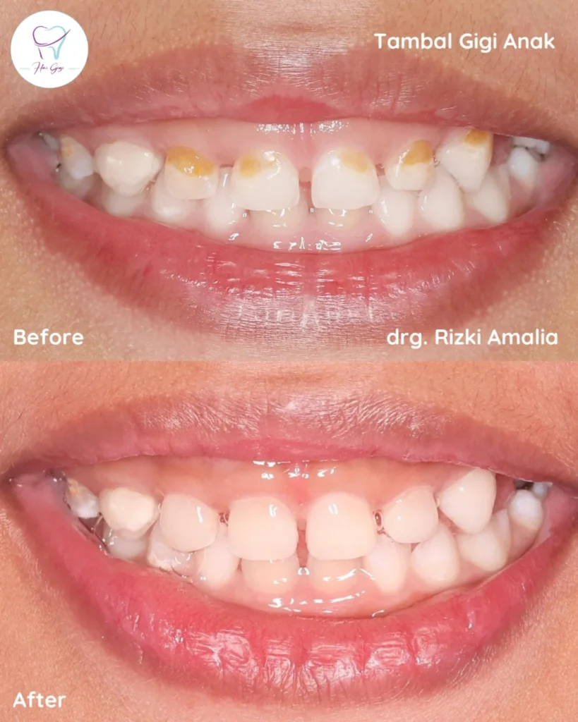 Perawatan Gigi Anak tambal-gigi-anak-hai-gigi-banyumanik
