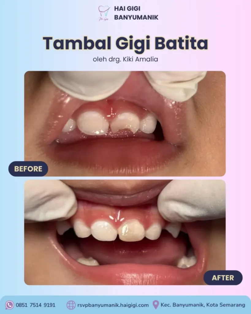 Perawatan Gigi Anak tambal-gigi-batita-hai-gigi-banyumanik