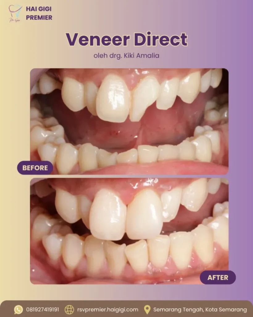 Veneer Gigi veneer-direct-5-hai-gigi-premier