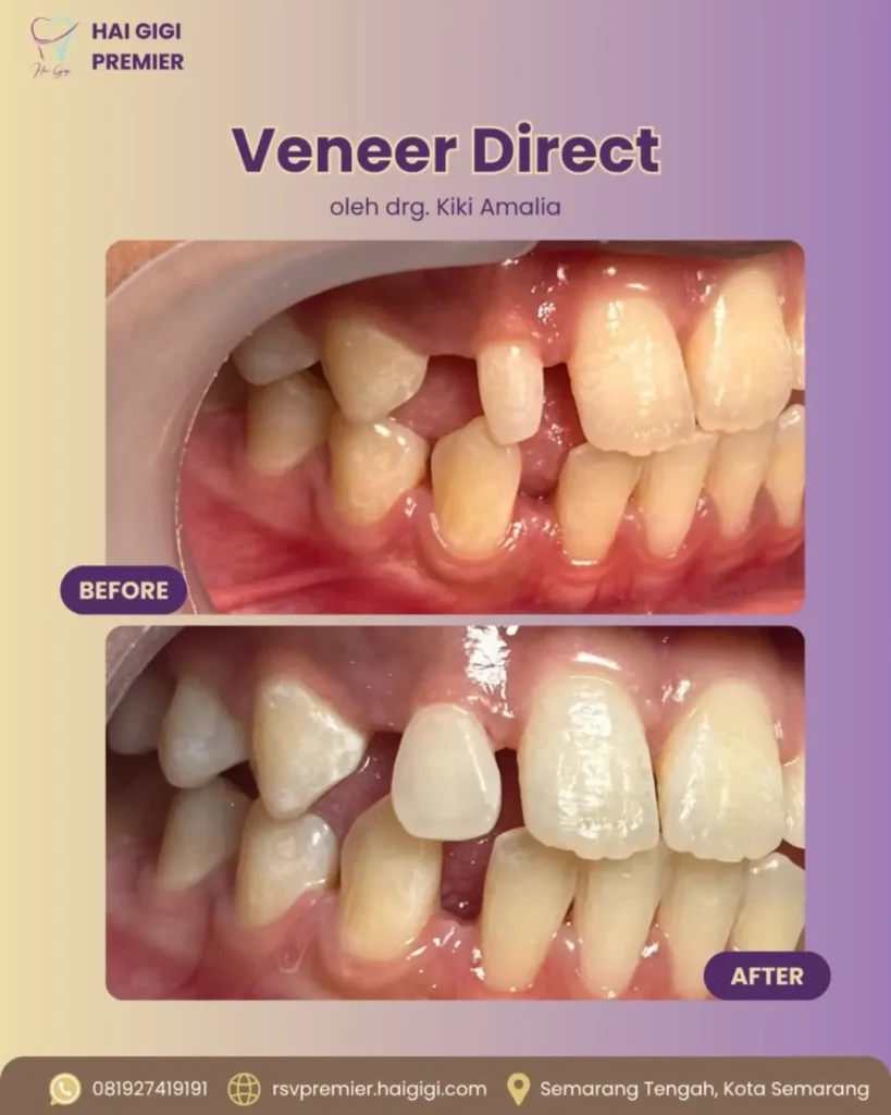 Veneer Gigi veneer-direct-6-hai-gigi-banyumanik