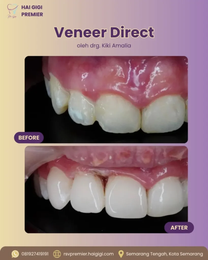 Veneer Gigi veneer-direct-6-hai-gigi-premier