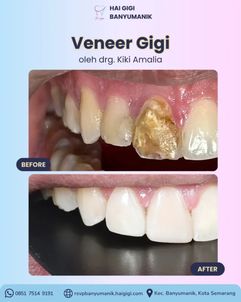 Veneer Gigi veneer-gigi-hai-gigi-banyumanik (2)