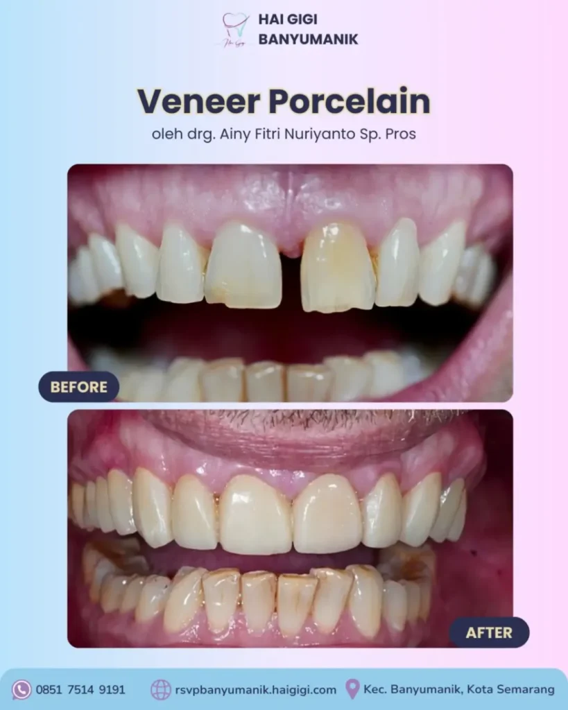 Veneer Gigi veneer-porcelain-hai-gigi-banyumanik
