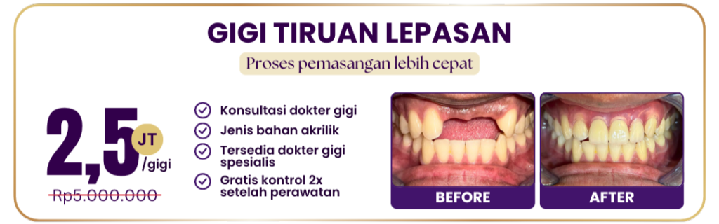 gigi-tiruan-lepasan-hai-gigi-premier