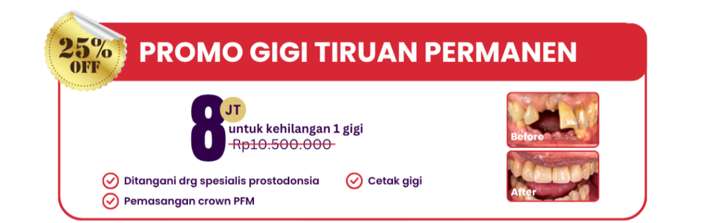 gigi-tiruan-permanen-hai-gigi-premier