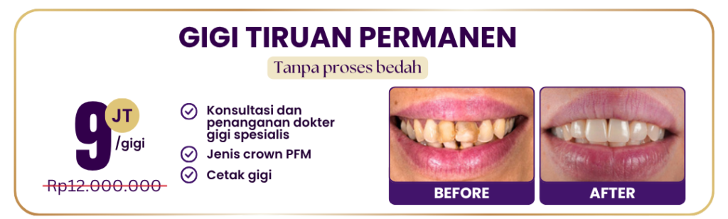 gigi-tiruan-permanen-hai-gigi-premier