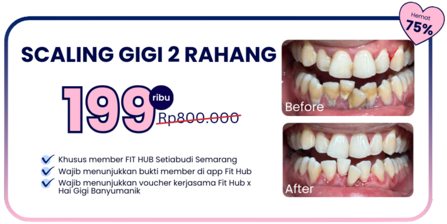 promo-hai-gigi-banyumanik-scaling