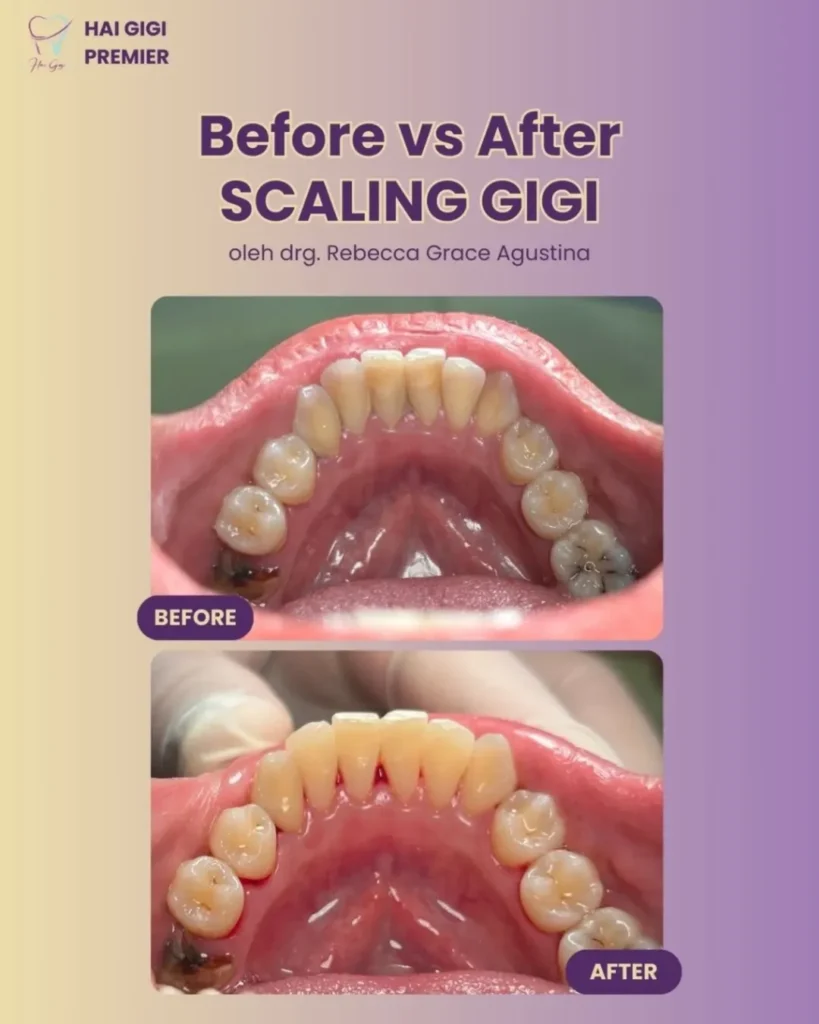 Scaling Gigi: Definisi, Tujuan, Manfaat, dan Harganya Scaling Gigi: Definisi, Tujuan, Manfaat, dan Harganya