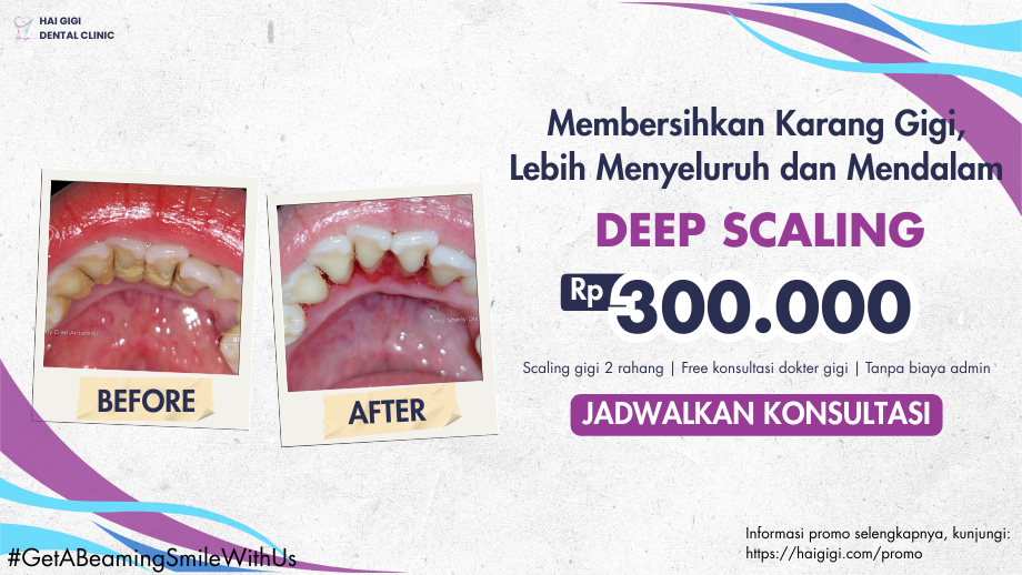 Scaling Gigi: Definisi, Tujuan, Manfaat, dan Harganya Scaling Gigi: Definisi, Tujuan, Manfaat, dan Harganya