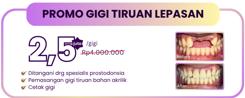 gigi-tiruan-lepasan-hai-gigi-premier