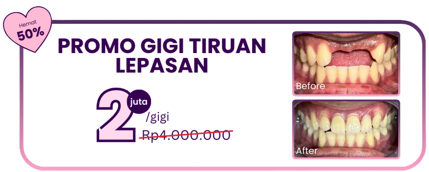 promo-hai-gigi-premier-gigi-tiruan-lepasan
