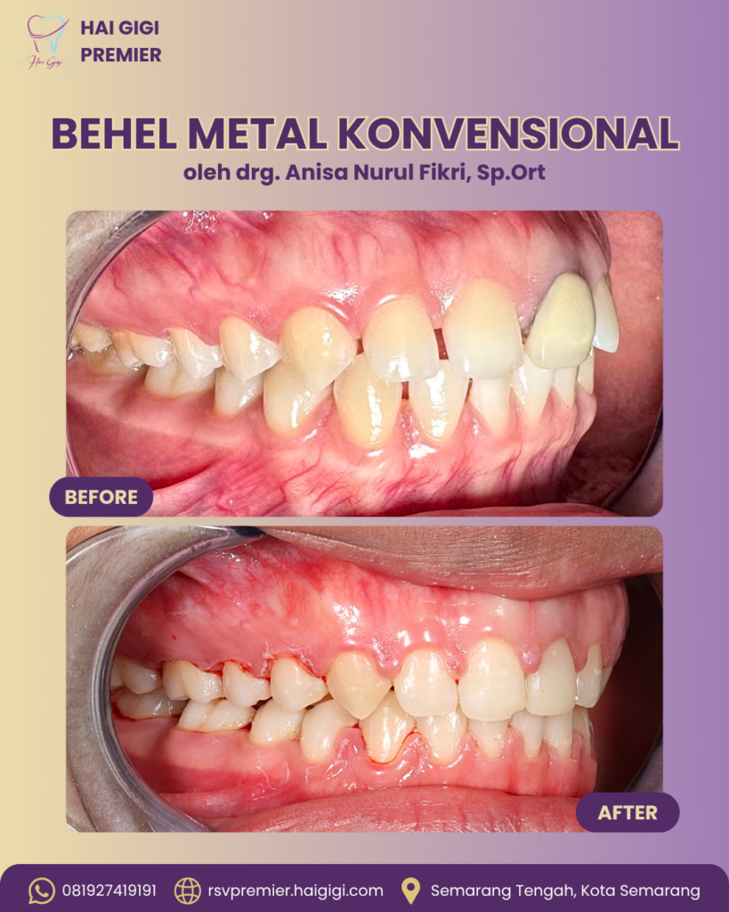 before-after-behel-gigi-metal-hai-gigi-premier (2)