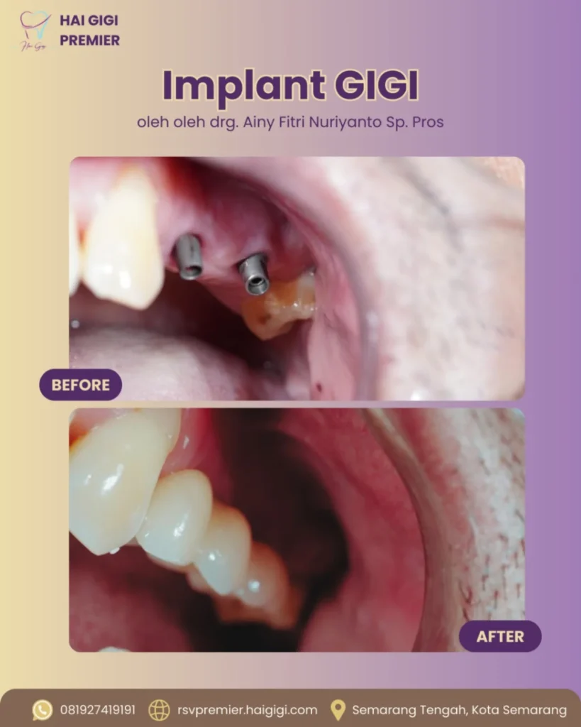 implan gigi semarang