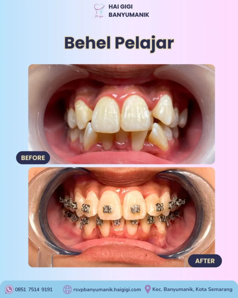 Promo Behel Luxury
