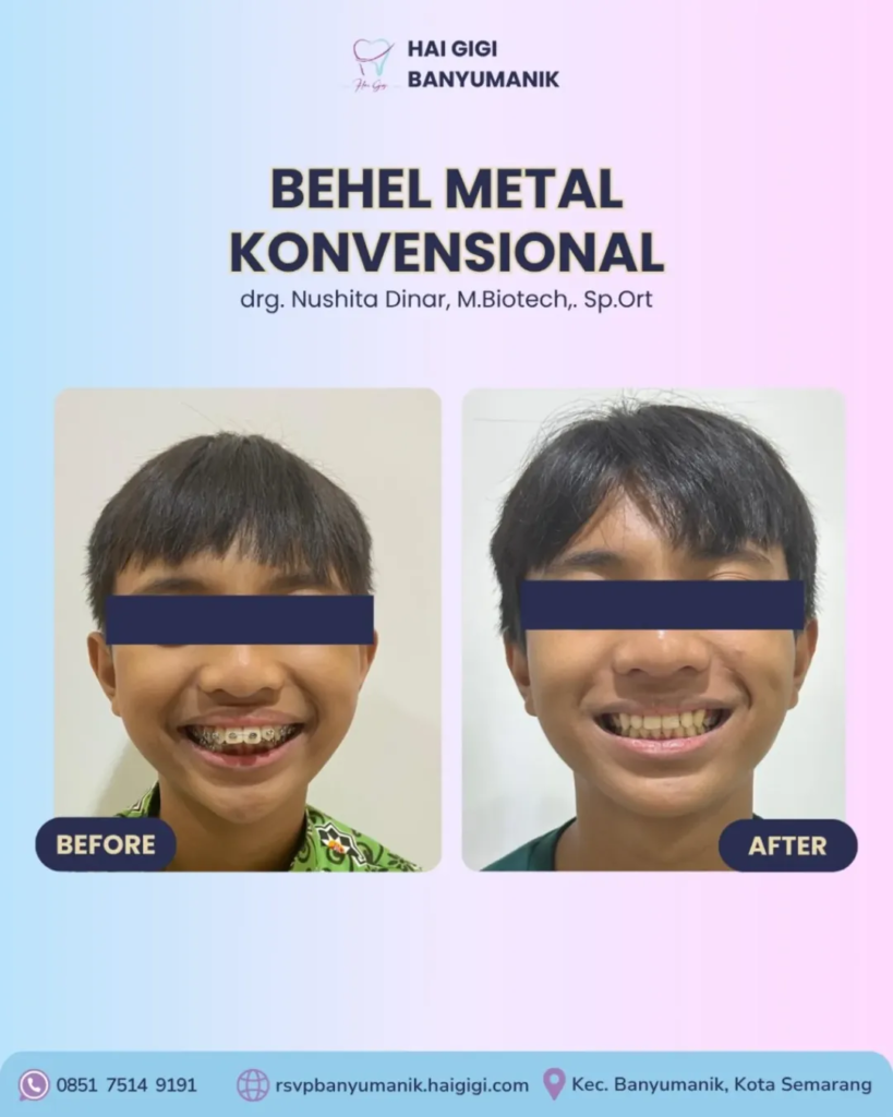 Promo Behel Luxury