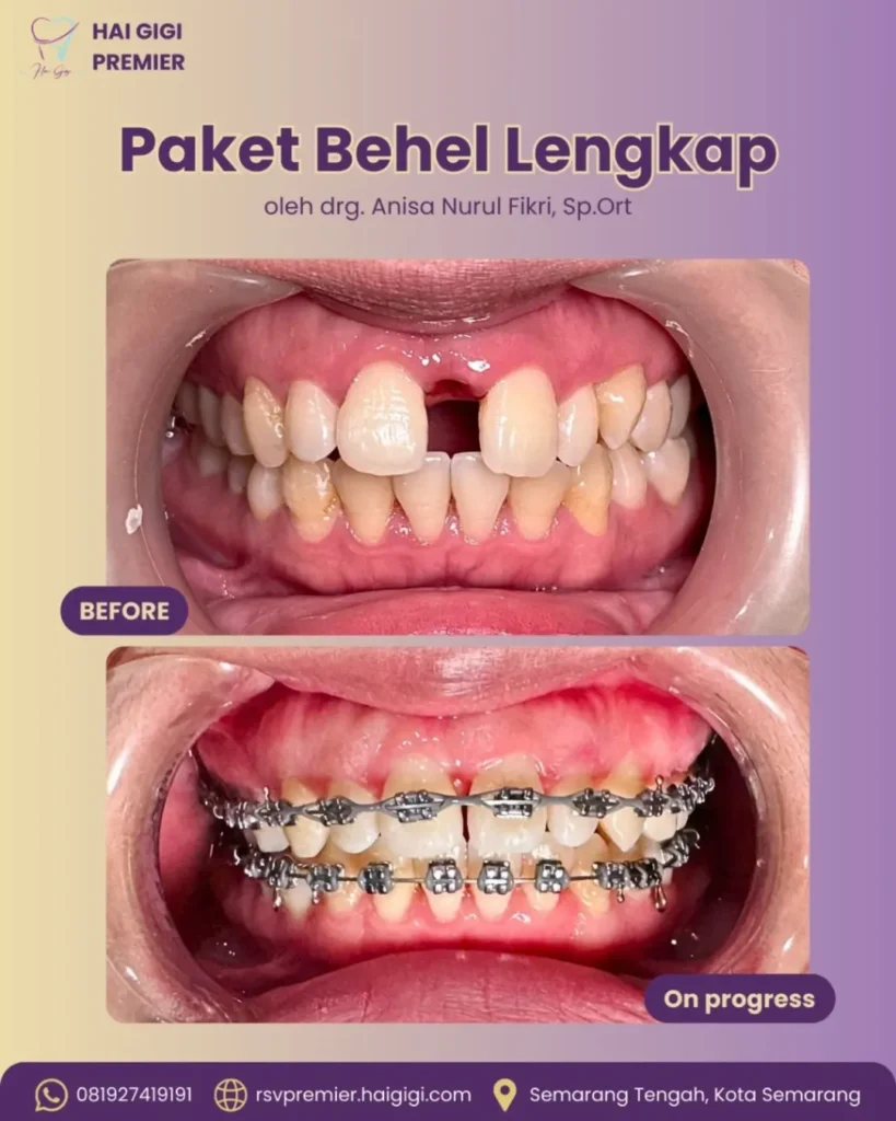 paket behel metal premier