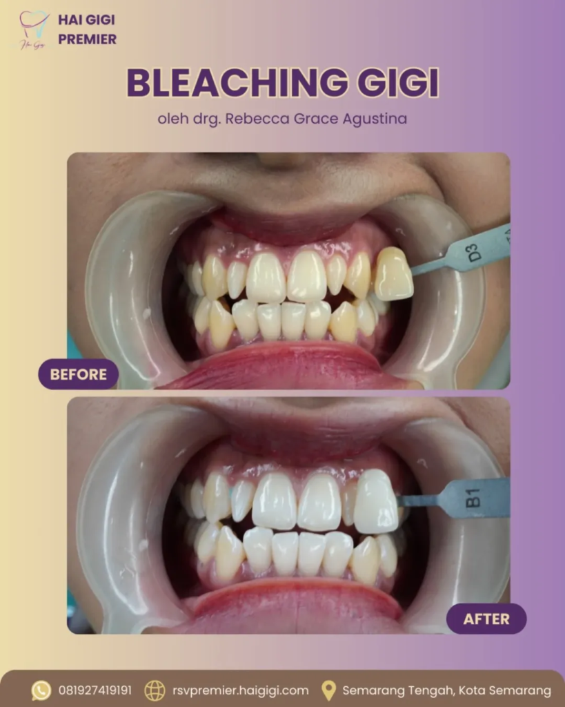bleaching-gigi-hai-gigi-premier