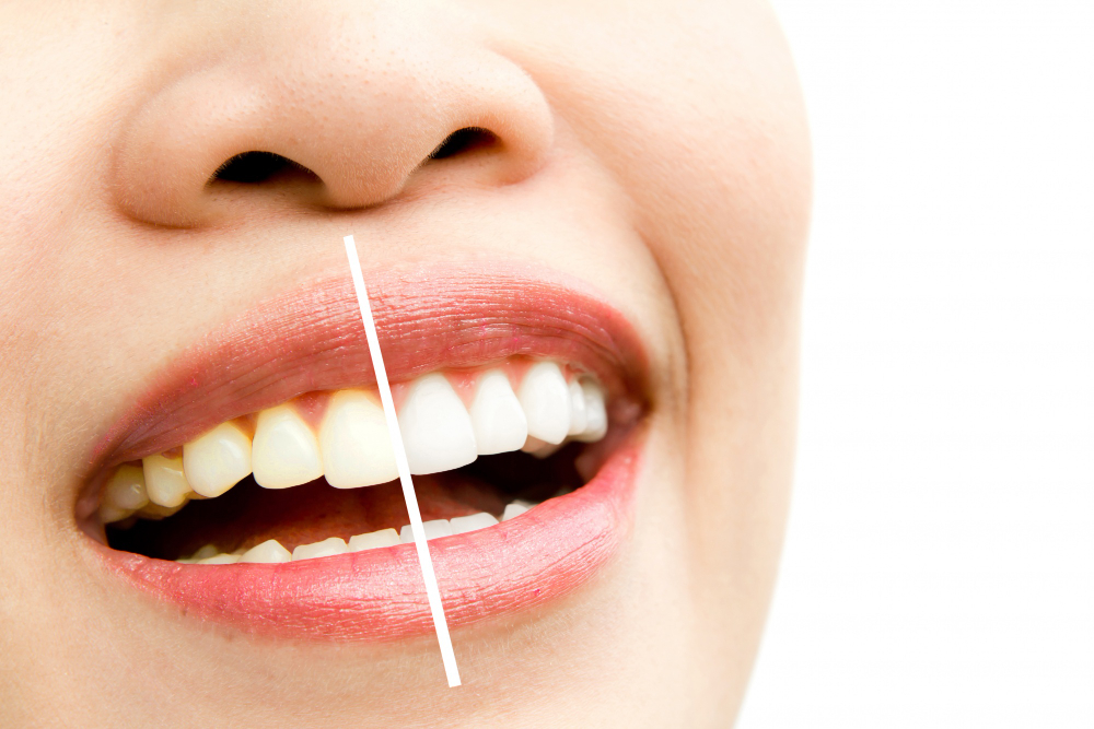 bleaching-hai-gigi-dental-clinic