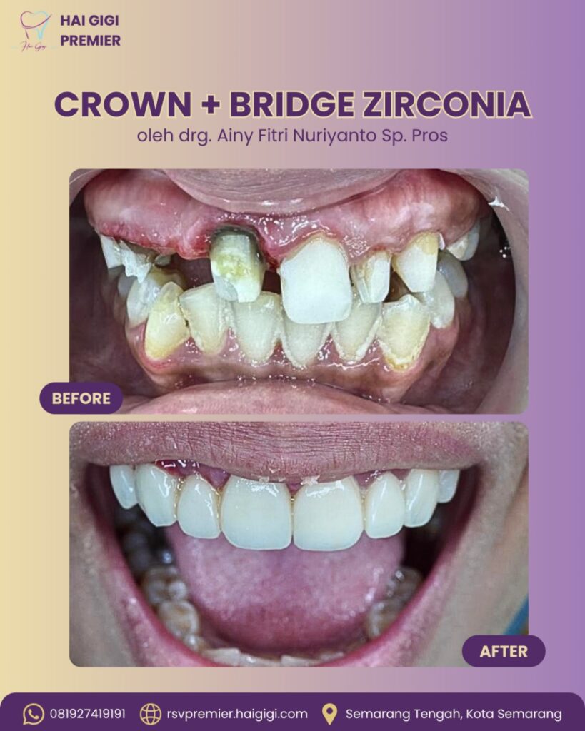 Promo Gigi Palsu crown-bridge-zirconia