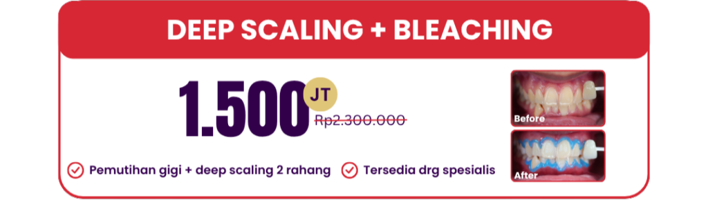 deep-scaling-bleaching-personal-hai-gigi-premier