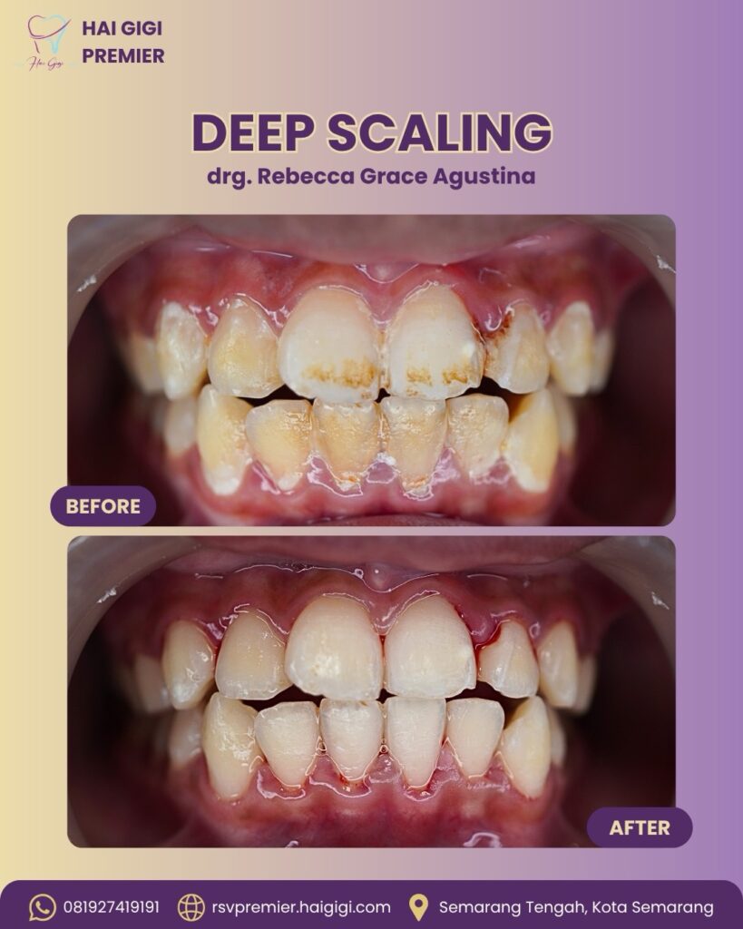 deep-scaling-hai-gigi-premier
