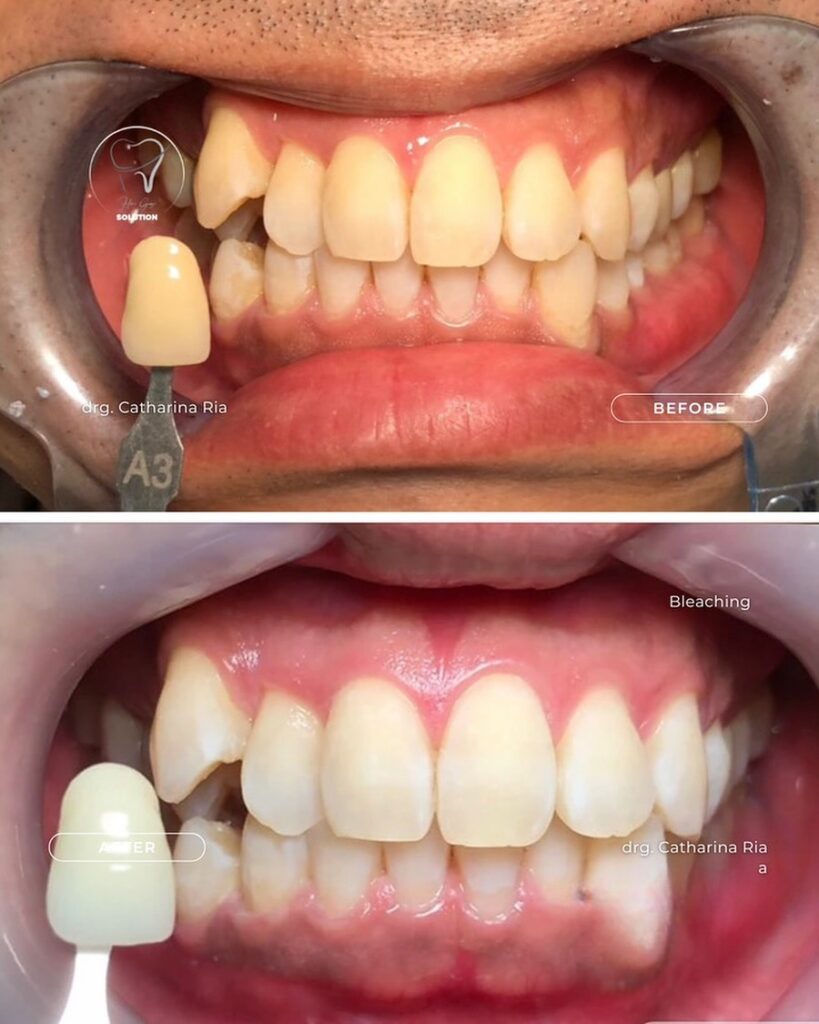 Apa itu Bleaching Gigi? Cek Proses dan Harganya! Apa itu Bleaching Gigi? Cek Proses dan Harganya!