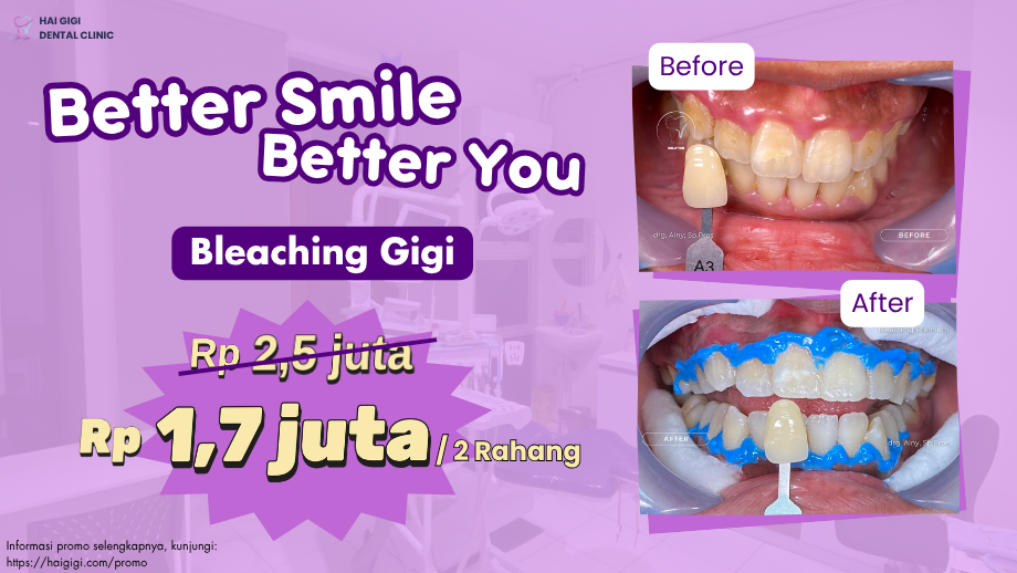 Apa itu Bleaching Gigi? Cek Proses dan Harganya! Apa itu Bleaching Gigi? Cek Proses dan Harganya!