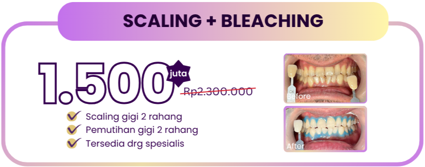 scaling-bleaching-hai-gigi-premier