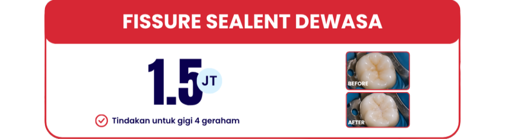 fissure-sealant-dewasa-hai-gigi-banyumanik