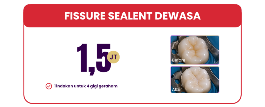 fissure-sealant-hai-gigi-premier