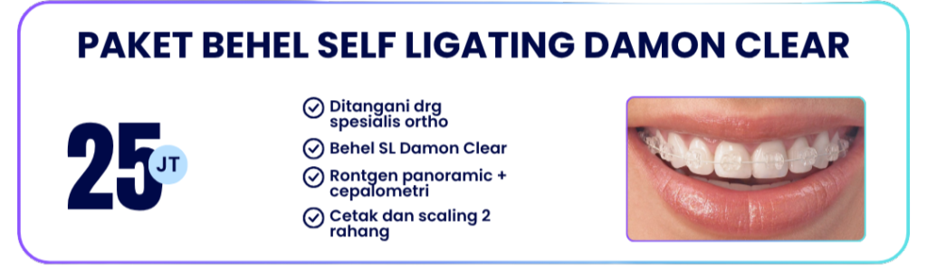 paket-self-ligating-damon-clear-hai-gigi-banyumanik