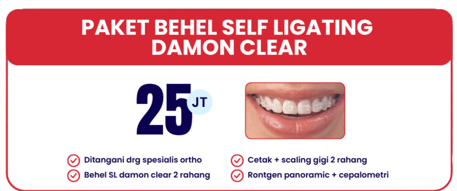 self-ligating-damon-clear-hai-gigi-banyumanik
