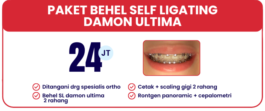 self-ligating-damon-ultima-hai-gigi-banyumanik